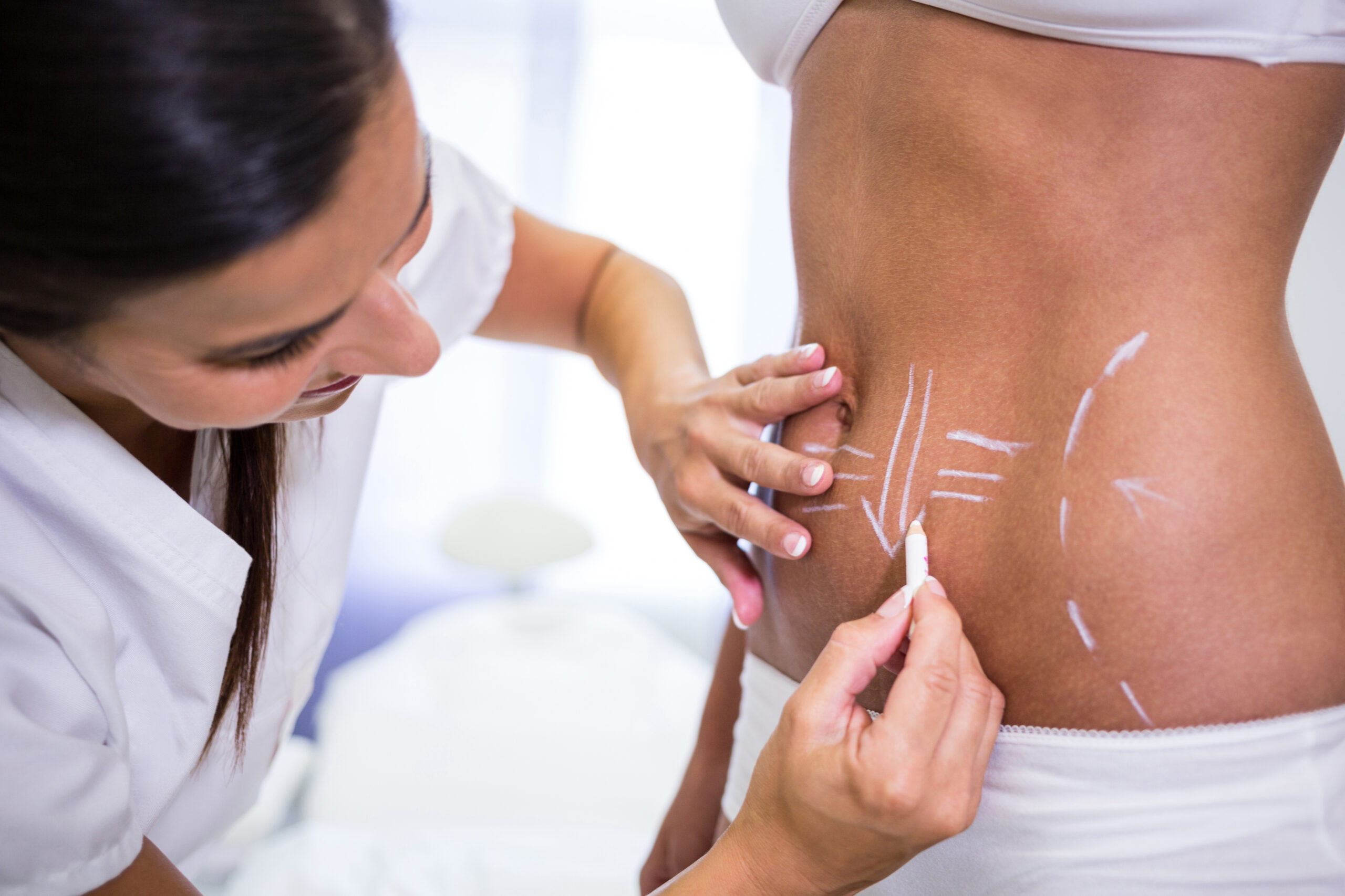 Close-up of surgeon drawing lines on womans abdomen for liposuction and cellulite removal